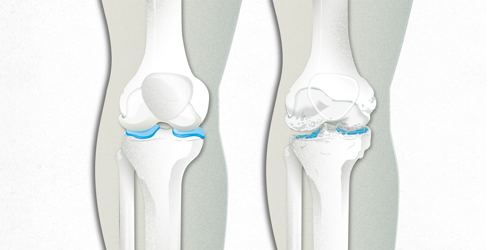 Artrosis o gonartrosis de rodilla. Síntomas y tratamiento