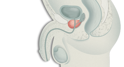 cancerul de prostata tablou clinic cancer de prostata idade minima