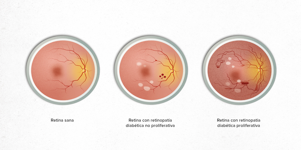 retinopatia diabetica no proliferativa clasificacion