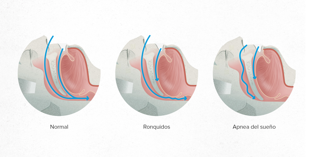 ▷Aparato Apnea Obstructiva del Sueño