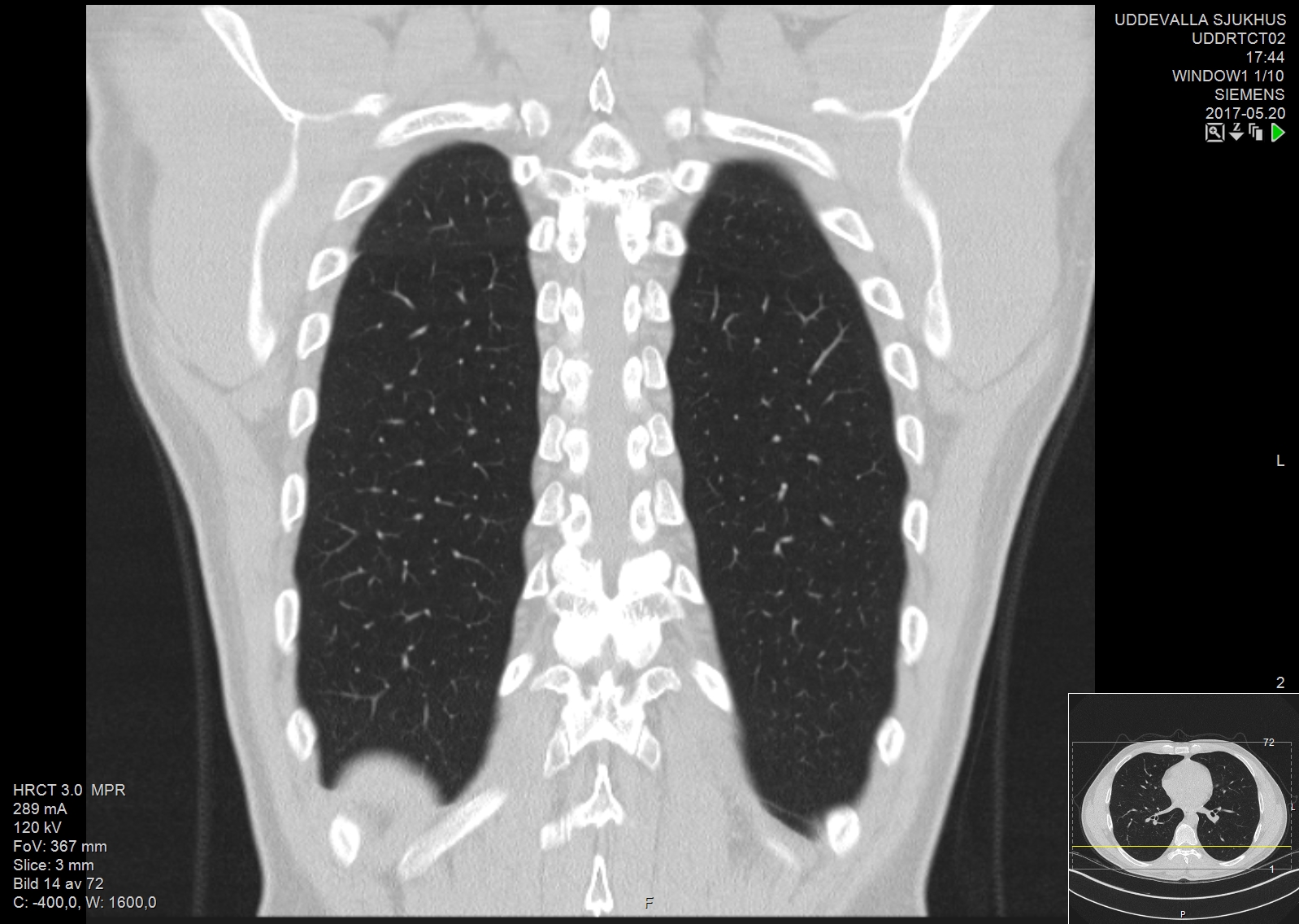 mesothelioma payouts uk