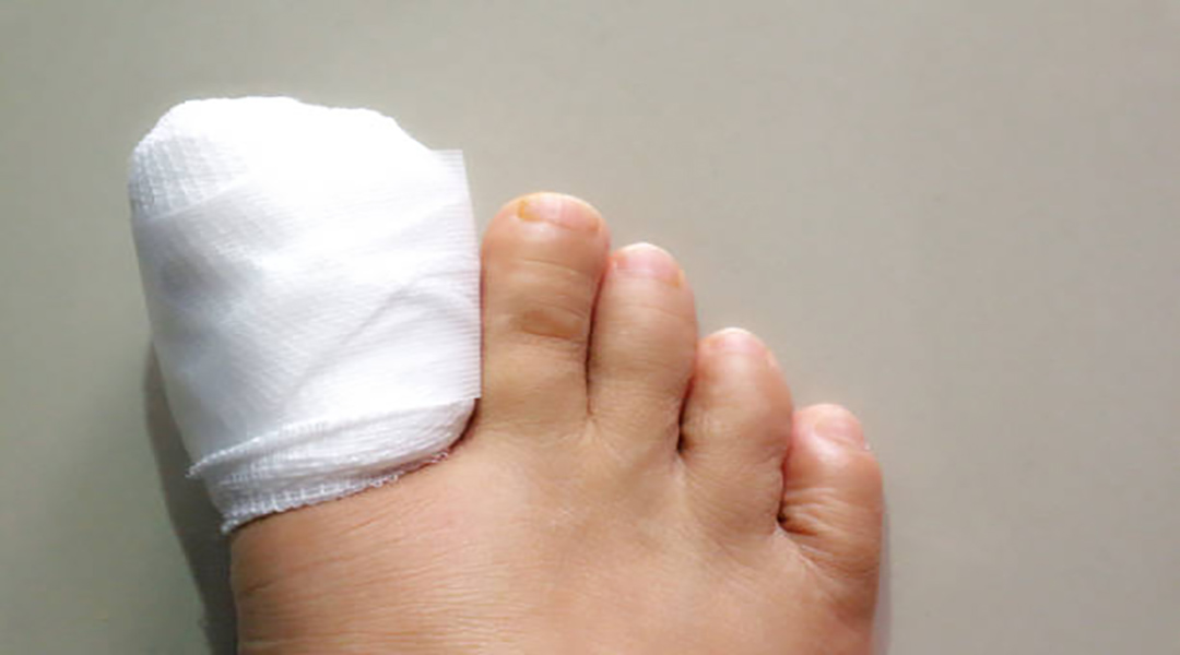 What are ingrown toenails and how are they treated?