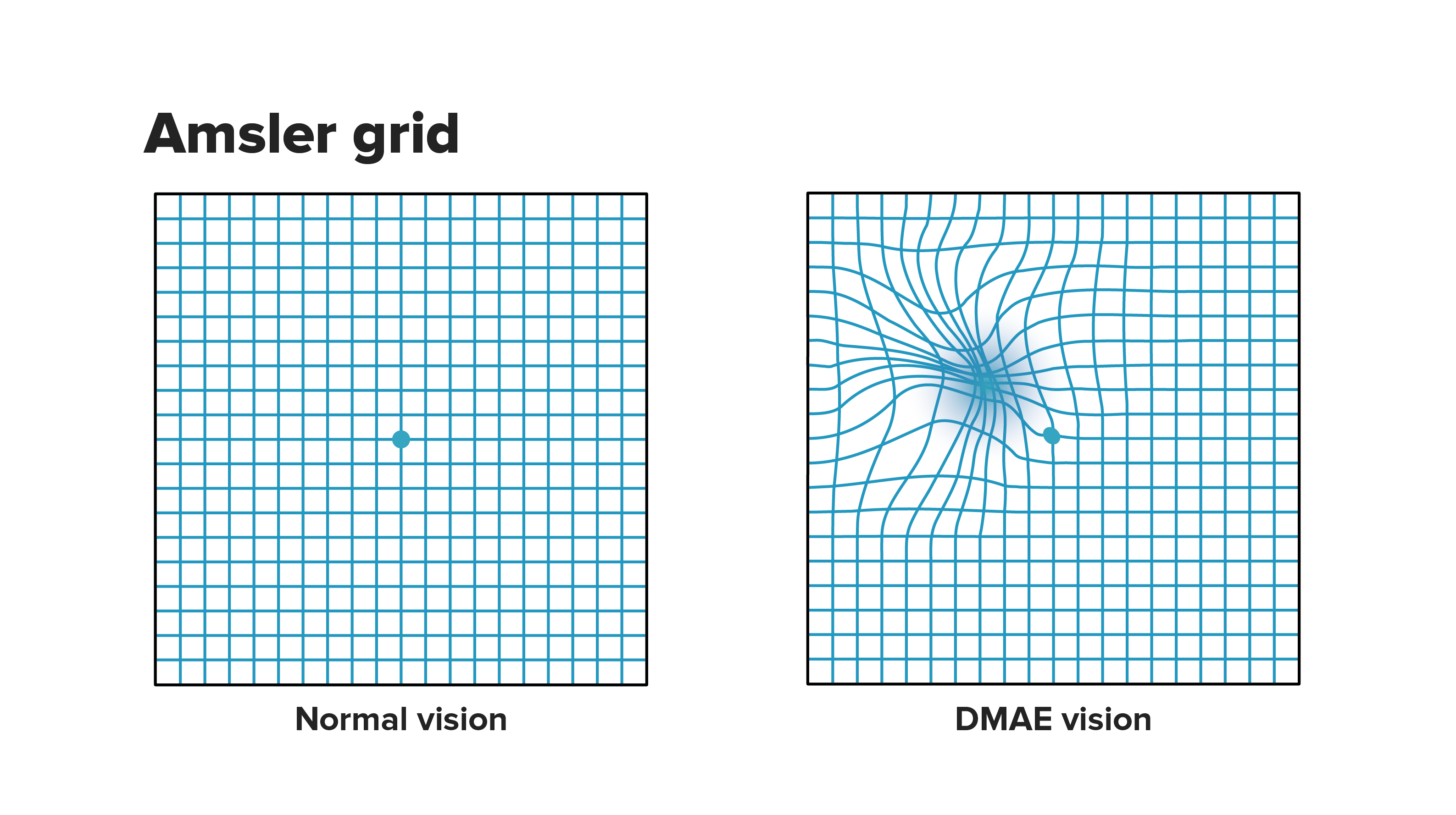 Amsler Grid Test for Retinal Conditions, When to See a Doctor