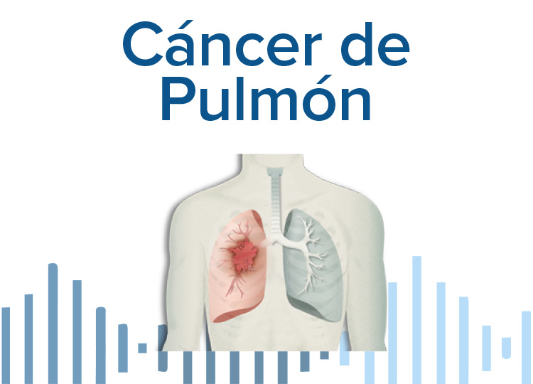 El tabaco es la principal causa del cáncer de pulmón | Cáncer de pulmón ...